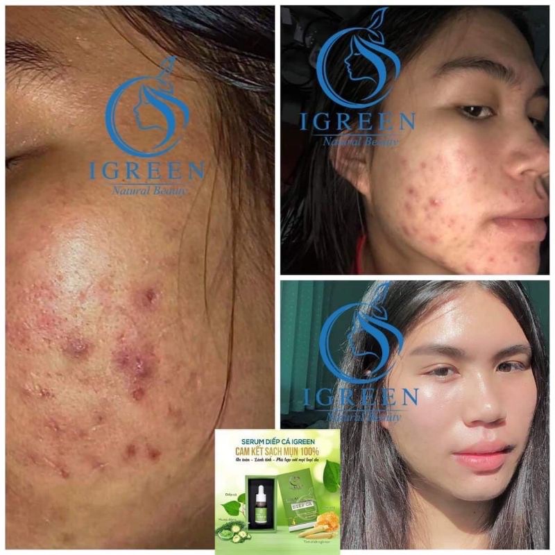 Serum diếp cá Igreen hết mụn giảm thâm se khít lỗ chân lông 10ml